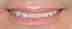 smile_teeth